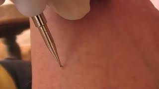 How to Use Laser Facial Mole Tattoo Removal Pen [upl. by Ecyob]