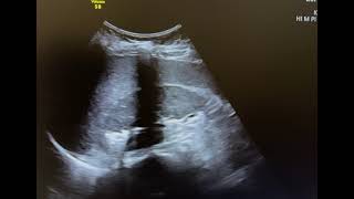 Ultrasound of emphysematous pyelonephritis [upl. by Arbua]