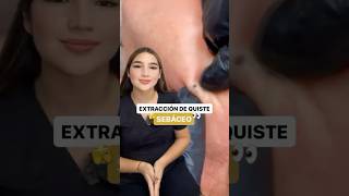 😱 ATENCIÓN ESPECIAL 🚨 para un Quiste Sebáceo 💆‍♀ [upl. by Iadahs]