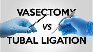 Vasectomy vs Tubal Ligation [upl. by Dove341]