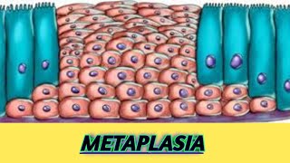 Metaplasia mechanism and examples  Dysplasia aplasia hypoplasia [upl. by Shaum920]