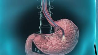 Learn about gastroscopy [upl. by Ellard]