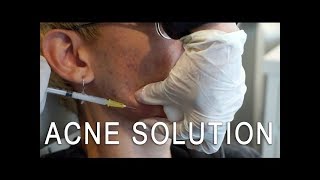 Cystic Acne Solution Kenalog Injection [upl. by Clim470]