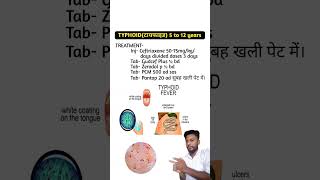 Typhoid टायफाइड 5 to 12 years treatment [upl. by Cataldo933]