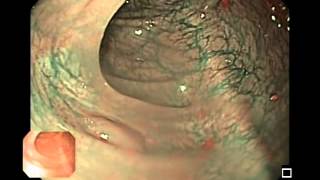 Hyperplastic Colon Polyps [upl. by Burn]