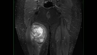 Synovial Sarcoma Thigh [upl. by Renell]