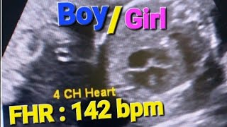 heartbeat ultrasound sound  heart rate boygirl  Fetal doppler heartbeat sound  fetal heart rate [upl. by Chemar843]