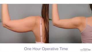 Get Firm Sculpted Arms With Smartlipo™  Dr Sterry Explains [upl. by Dacie]