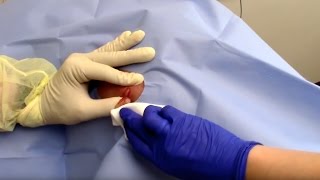 Abscess Drainage Performed by Dermatologist Dr David Myers [upl. by Huebner]