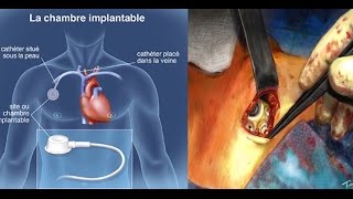 Chambre implantable de perfusion port a cath mise en place chirurgicale animation [upl. by Otrebor636]