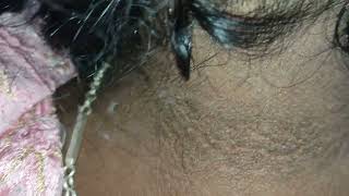 what are disease associated with acanthosis nigricans [upl. by Aihsein848]