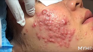 Cystic Pustules Acne Extractions EP14 No Clickbait [upl. by Ettenoitna]