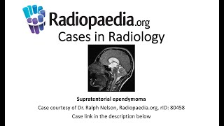 Supratentorial ependymoma Radiopaediaorg Cases in Radiology [upl. by Kemppe875]