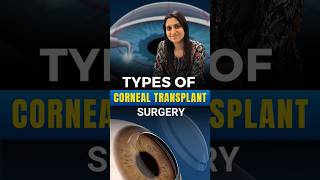 Types Of Corneal Transplant Surgery [upl. by Aliwt]