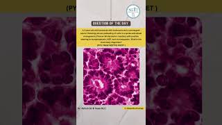 Options are  A Neuroblastoma B Medulloblastoma C Retinoblastoma D Rhabdomyosarcoma [upl. by Ellirpa]