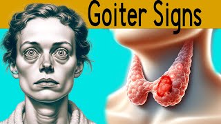 Goiter explained under 3 minutes Causes Symptoms Treatment [upl. by Idnerb559]