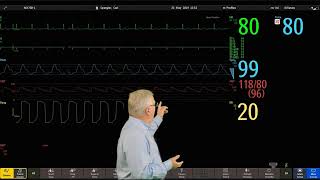 Philips IntelliVue Patient Monitoring  4  Changing Wave Order [upl. by Sharona]