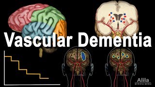 Vascular Dementia Pathology Animation [upl. by Cogen]