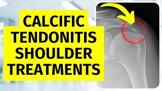 Calcific Tendonitis Shoulder Treatments Without Surgery [upl. by Assiluy817]