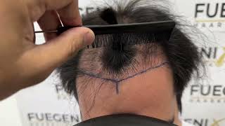 Hair Restoration From Failed Transplant to Hope  Hair Transplant  FueGenix  Dr Munib Ahmad [upl. by Nancy]