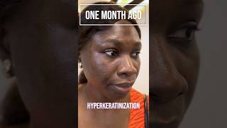 Meet Ms Adeola 🤩✨ who tackled HyperMelanosis with our Hyperpigmentation Treatment Protocol HTP✨ [upl. by Einad]