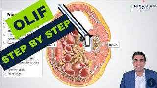 OLIF Oblique Lateral Interbody Fusion  Procedure details recovery expectations and more [upl. by Esnahc988]