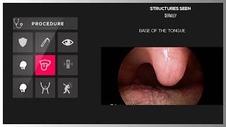 DIRECT LARYNGOSCOPY [upl. by Enineg]