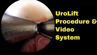 Narrated UroLift Procedure Video as shown using Redfin R3800 Digital Video System for Cystoscopy [upl. by Krishna704]