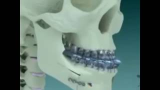 BI JAW SURGERY Class III Occlusion Dentistry  Best Orthognathic Surgery Video Easy Animation [upl. by Johm]