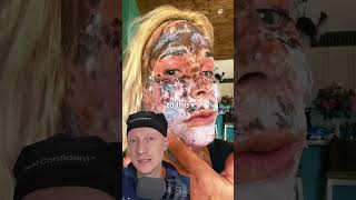 SHOCKING CO2 Laser Recovery Is Normal  Plastic Surgeon Reacts [upl. by Lewej]