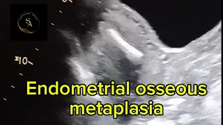 Endometrial osseous metaplasia [upl. by Ruenhcs]