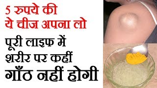 शरीर में कभी कोई गाँठ नहीं होगी ऐसा शानदार घरेलू नुस्खा है ये Cyst Removal by Sachin Goyal [upl. by Adnotal]