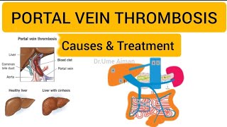 Portal Vein Thrombosis  How to treat PVT  in HindiUrdu [upl. by Tamra]