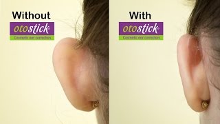 New Otostick Cosmetic Ear Correctors  A solution for prominent ears [upl. by Earb]