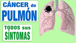 Todos Los Síntomas del Cáncer de Pulmón [upl. by Noyr]