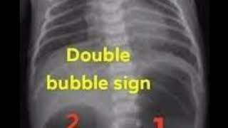 Duodenal atresia  remember 4 Ds Duodenal atresia double bubble sign down syndrome Duodeostomy [upl. by Lema314]