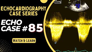 Echocardiography Case 85  Echo Case Series  Echocardiogram Interpretation made easy for Beginners [upl. by Warde]