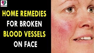 Home Remedies for Broken Blood Vessels on Face  Health Sutra  Best Health Tips [upl. by Ltihcox]