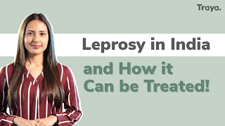 Leprosy in India and how it can be treated  World Leprosy Day [upl. by Erreipnaej367]