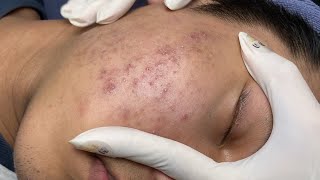 ACNE TREATMENT VU QUYNH MI  Blackheads On Boy Face 2024FULL [upl. by Fabriane734]