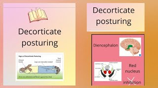 Decorticate and decerebrate rigity [upl. by Ayrad625]