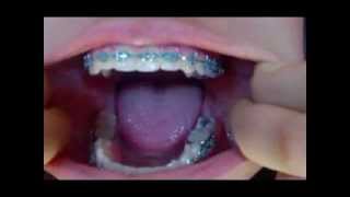 BEST BRACES CLOSEUP  FILLINGS VIDEO EVER [upl. by England]