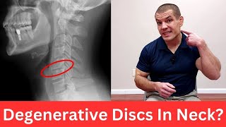 3 Exercises For Cervical Degenerative Disc Disease Relieve Neck Pain [upl. by Anaibib]