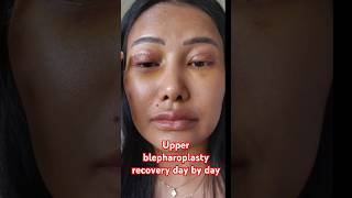 Upper blepharoplasty recovery day by day [upl. by Kone122]