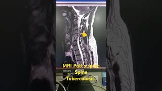 MRI Potts spine bone TB tuberculosis shortvideo shorts viralshorts [upl. by Marlea]