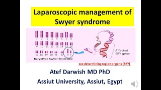 Laparoscopic management of Swyer syndrome [upl. by Naud]