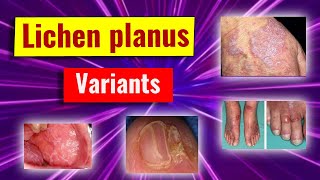 Clinical variants of lichen planus [upl. by Libbey]