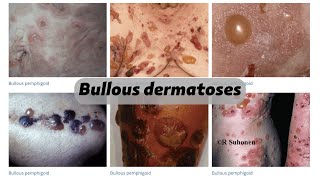 Bullous dermatoses [upl. by Anaylil]