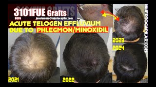 3101GraftsDUPAAcute telogen effluvium at 18mthsdue to phlegmonminoxInjertocapilarcom26572021 [upl. by Keemahs]