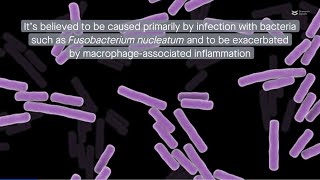 The root of the problem F nucleatum triggers cell death in apical periodontitis via ZBP1 [upl. by Ynnep]